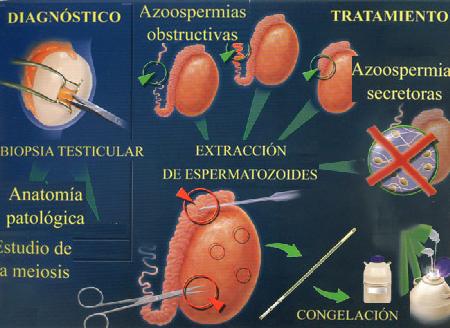 Imagen Biopsia testicular