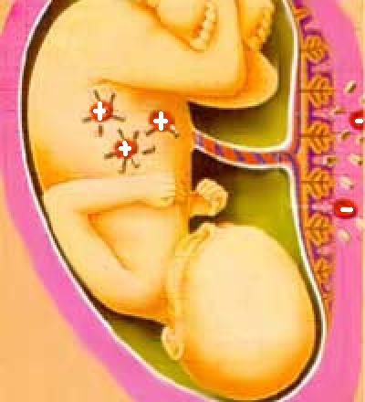 Bebé con Rh positivo recibiendo a través del cordón umbilical 