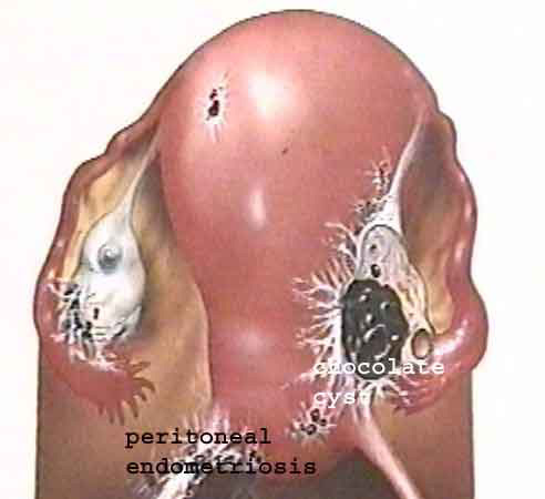 Imagen endometriosis