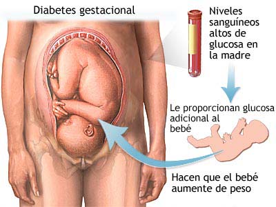Diabetis gestacional